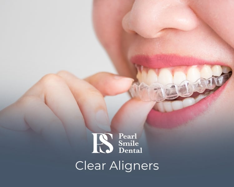 invisalign whitening didsbury